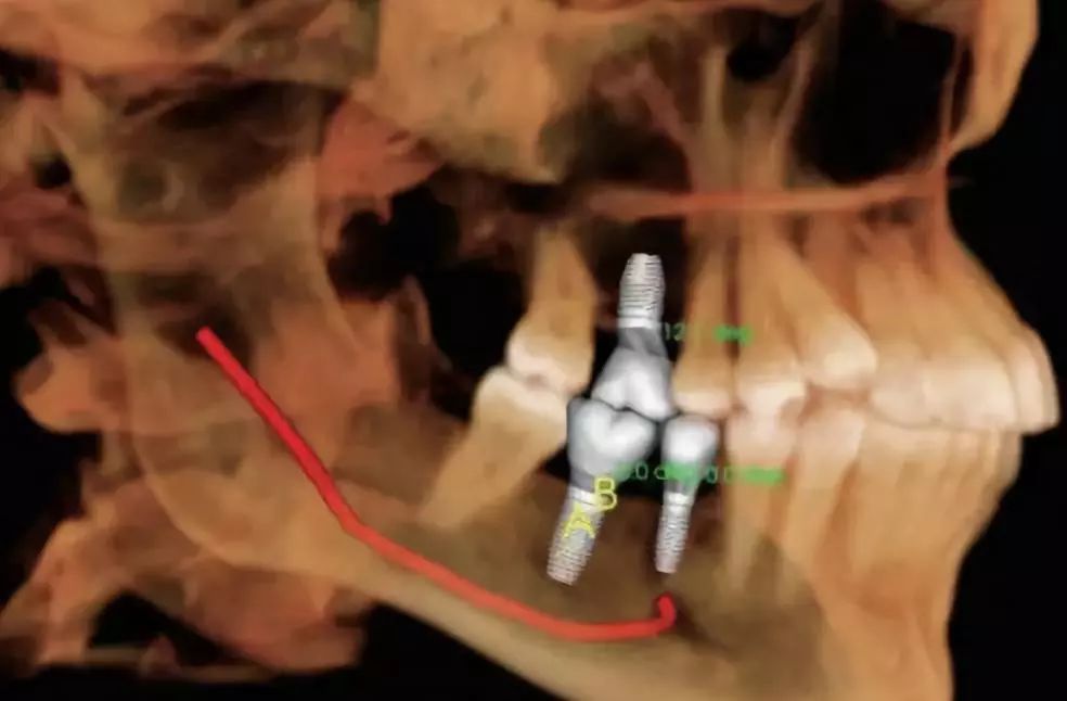 牙科三维CT